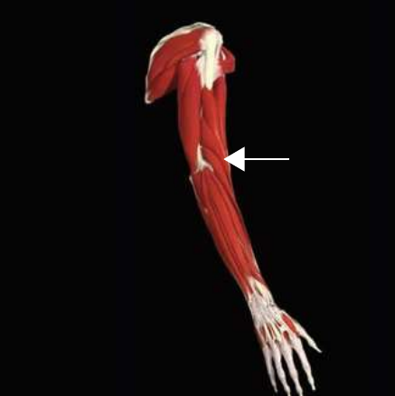 Brachioradialis highlighted on the forearm musculature