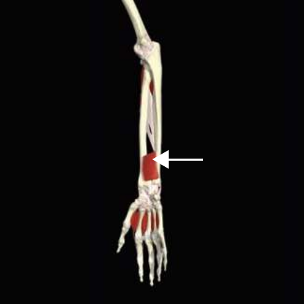 Pronator quadratus highlighted at the distal forearm