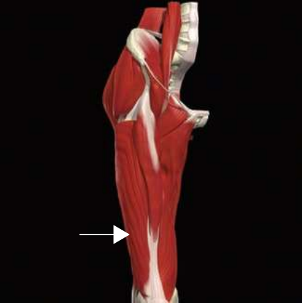 Vastus lateralis, the largest of the quadriceps heads