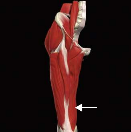 Vastus medialis, the teardrop above the inner knee