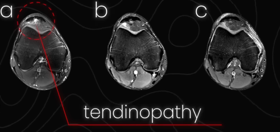 MRI cross-section of a patellar tendon showing tendinopathy in an NBA athlete