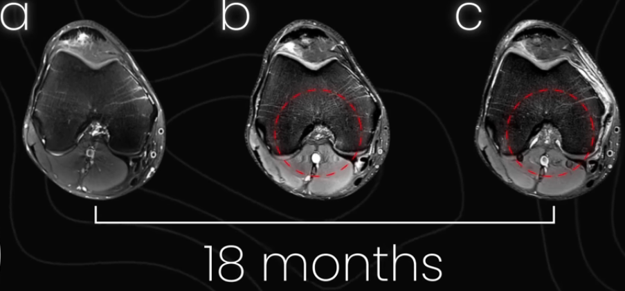 Same patellar tendon at 18 months — images b and c showing healed, reorganised tissue