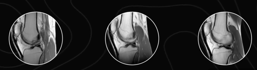 Three MRI side-views of the same knee, showing tendon thickening from a thin, compromised structure to a substantially denser tendon after 18 months of loading